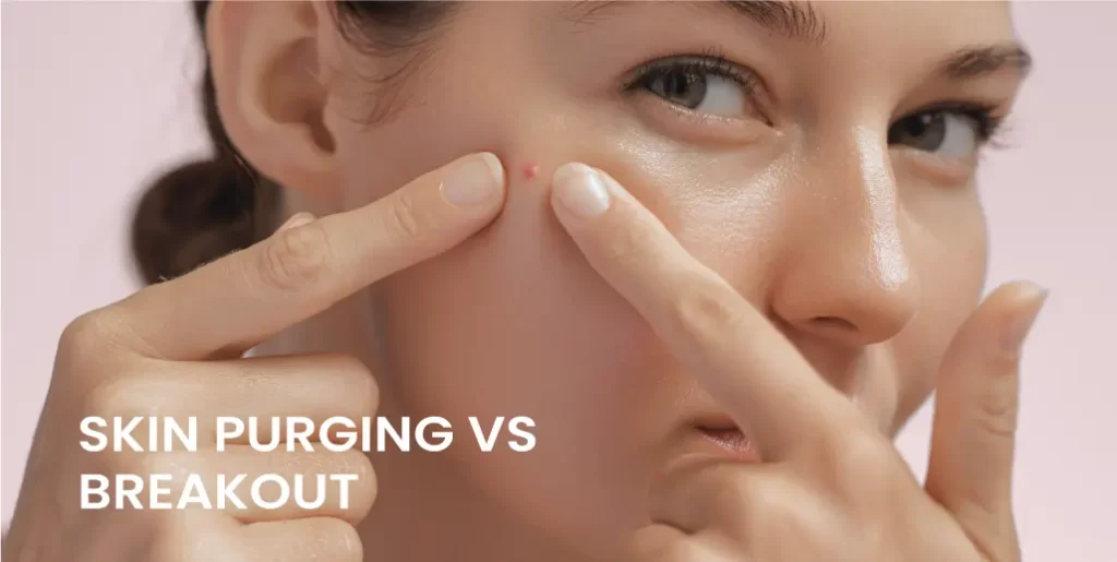 Skin Purging vs Breakout